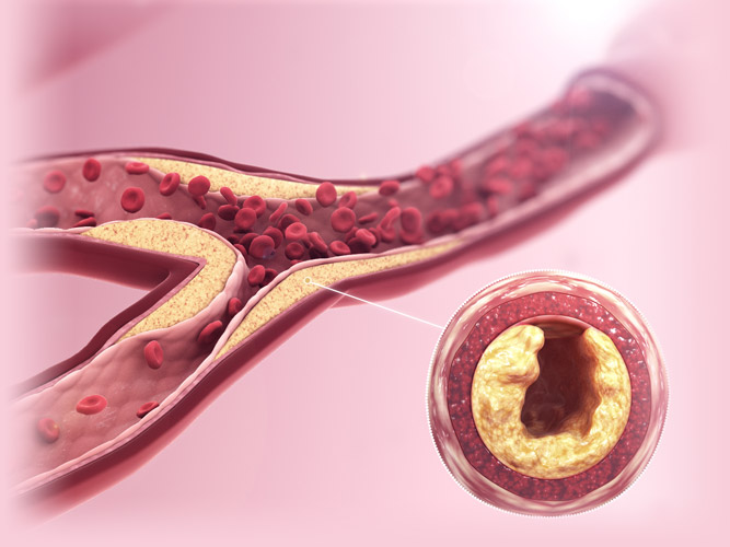 Calcium Deposits in the Arteries