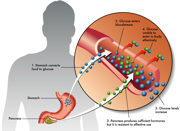How Metabolic Hormone Resistance Affects Blood Sugar Levels