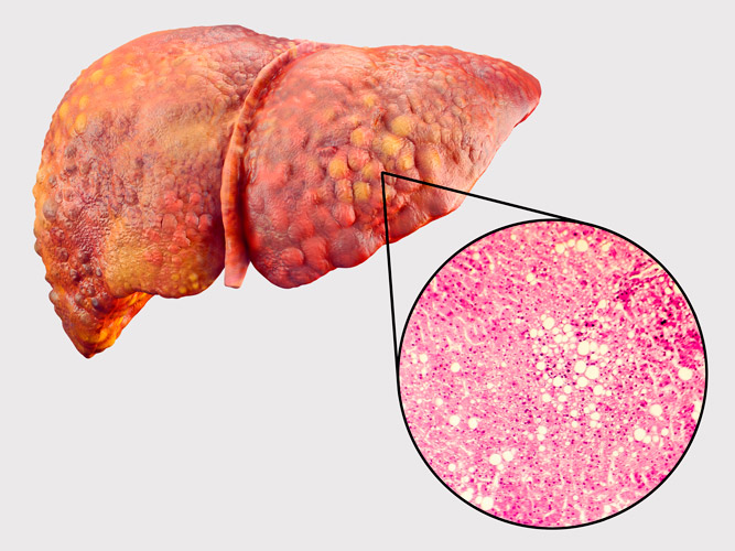 Liver with Fat Buildup