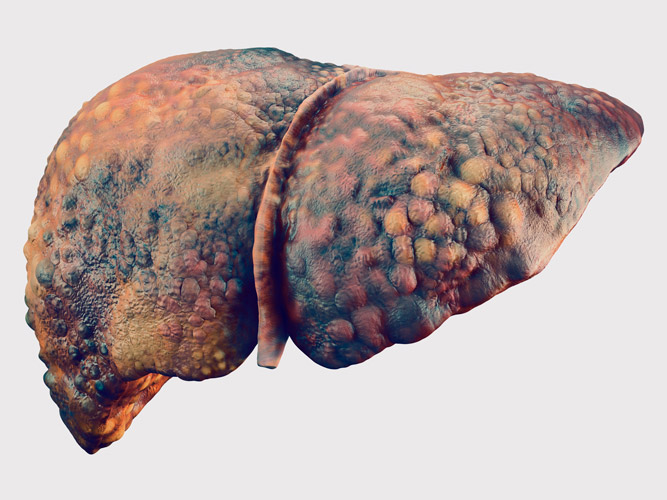 Liver with Cirrhosis