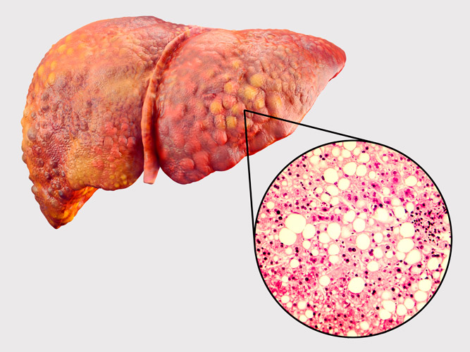 Liver with More Fat Buildup