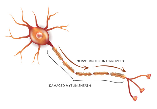 Damaged Myelin Sheath