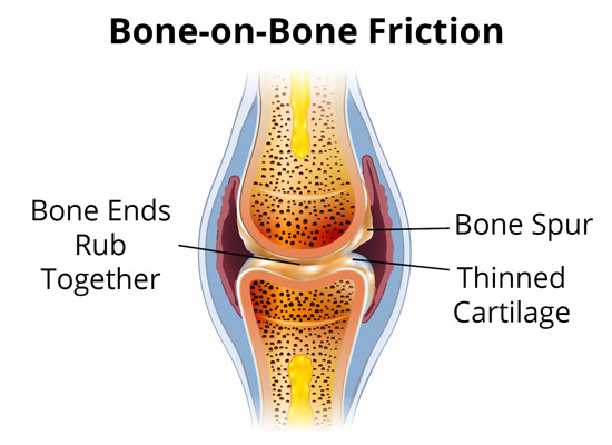 Bone-on-Bone Friction