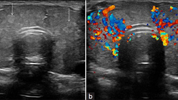 Difference Between Normal and Hypoactive Thyroid